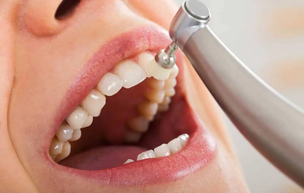 Implanturi dentare: O soluție rapidă și eficientă pentru zâmbetul tău