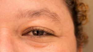 Photo Eyelash loss