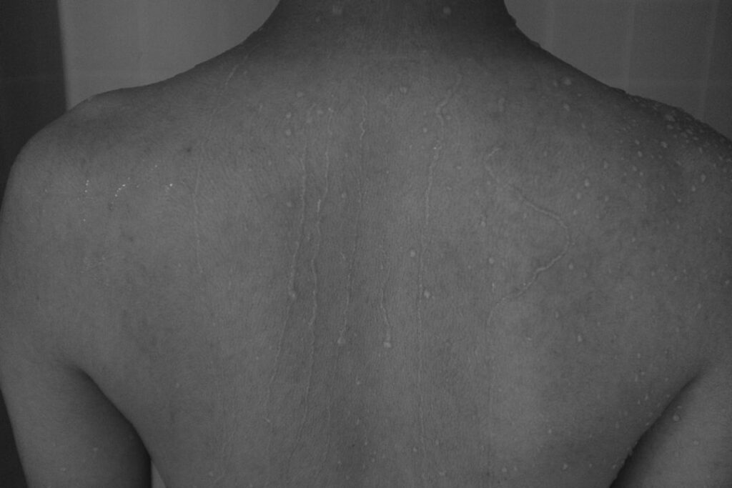 Photo Iron deficiency: Pale skin